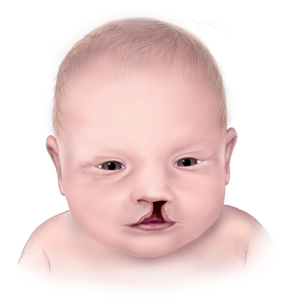 Görsel 8: Yarık dudaklı bebek