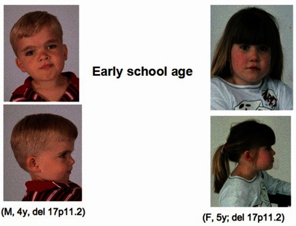Görsel 1: Smith-Magenis sendromlu çocuklar