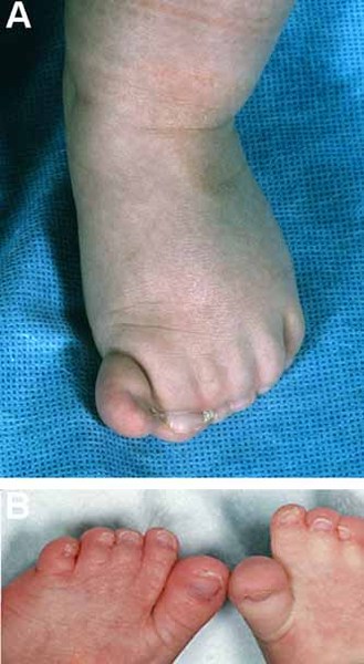 Görsel 2: Ayak parmaklarının deri sindaktili