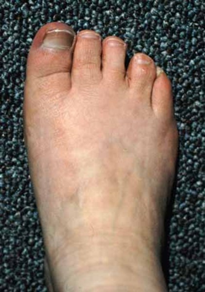 Görsel 3: Kısa ayak parmakları (ayağın brakidaktili)