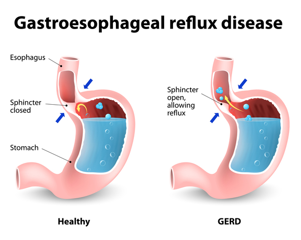 Görsel 3: Gastroözofageal reflü hastalığı (GÖRH)