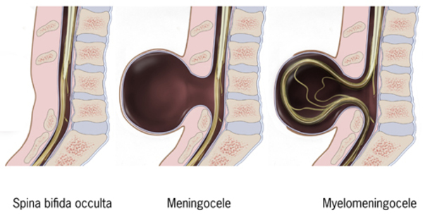 Görsel 4: Spina bifida türleri: spina bifida occulta, meningosel ve miyelomeningosel