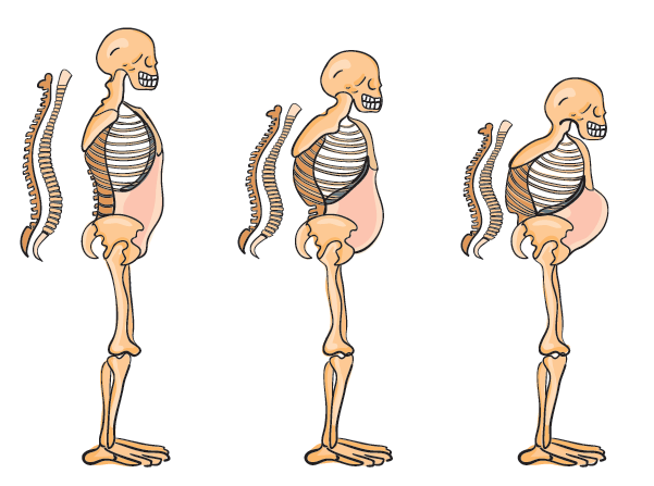 Görsel: Böbrekler ve kemik doku kadmiyumdan en çok etkilenen organlardır. Kemik yoğunluğunda azalma, kemiklerde yumuşama görülür ve omurilik doğal şeklini kaybeder.