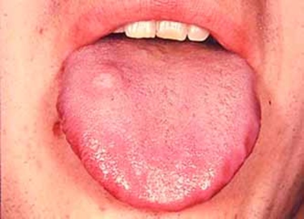 Görsel 3: Beckwith wiedemann Sendrom; Büyük dil (makroglossia)/NCBI