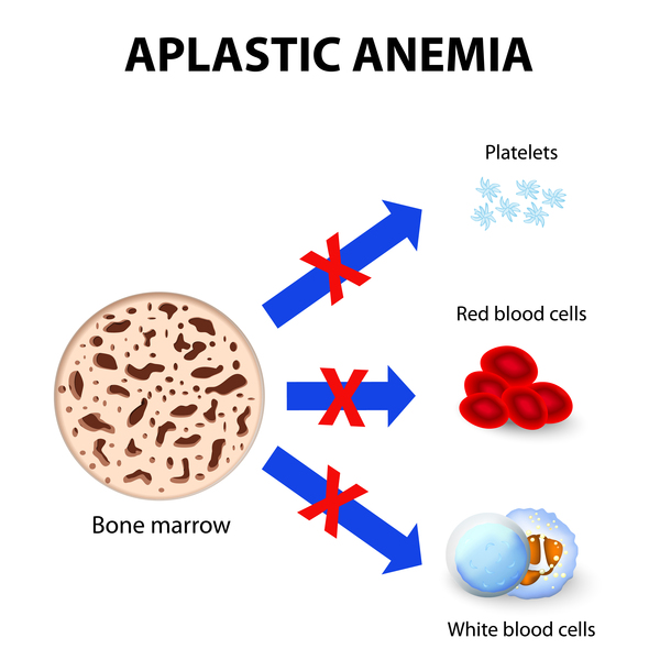 Görsel 2: Aplastik anemi