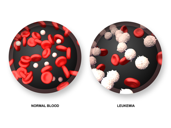 Görsel 3: Lösemiden etkilenen kanla karşılaştırıldığında normal kan