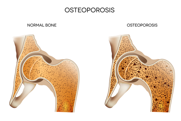 Görsel 4: Osteoporoz