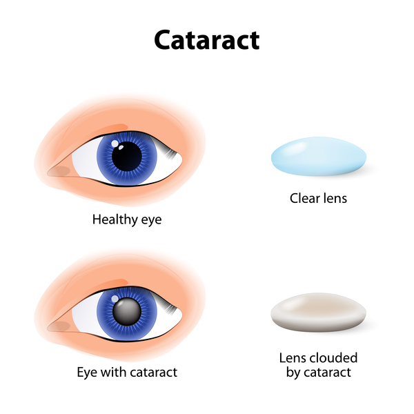 Görsel 3: Katarakt ile sağlıklı göz ve göz/NCBI
