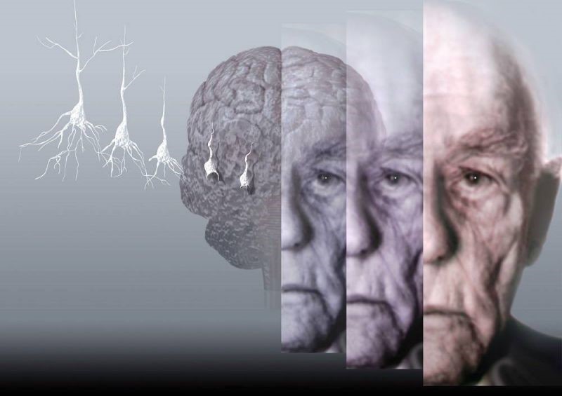 Şekil 6: Beyin hücrelerinin ölümü Alzheimer hastalığı nedenlerindendir.