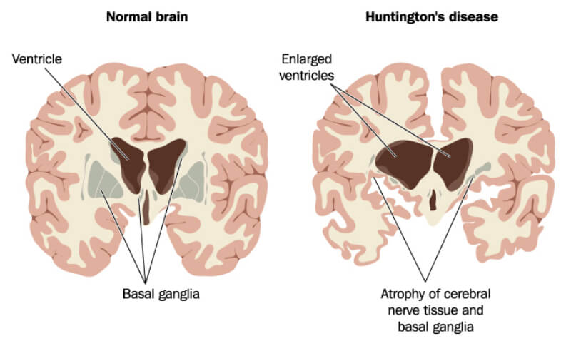 huntingtonlu bireyin beyin yapısı